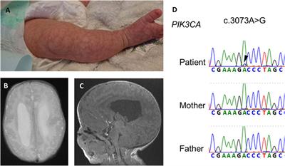 Case report: Progressive pulmonary artery hypertension in a case of megalencephaly-capillary malformation syndrome